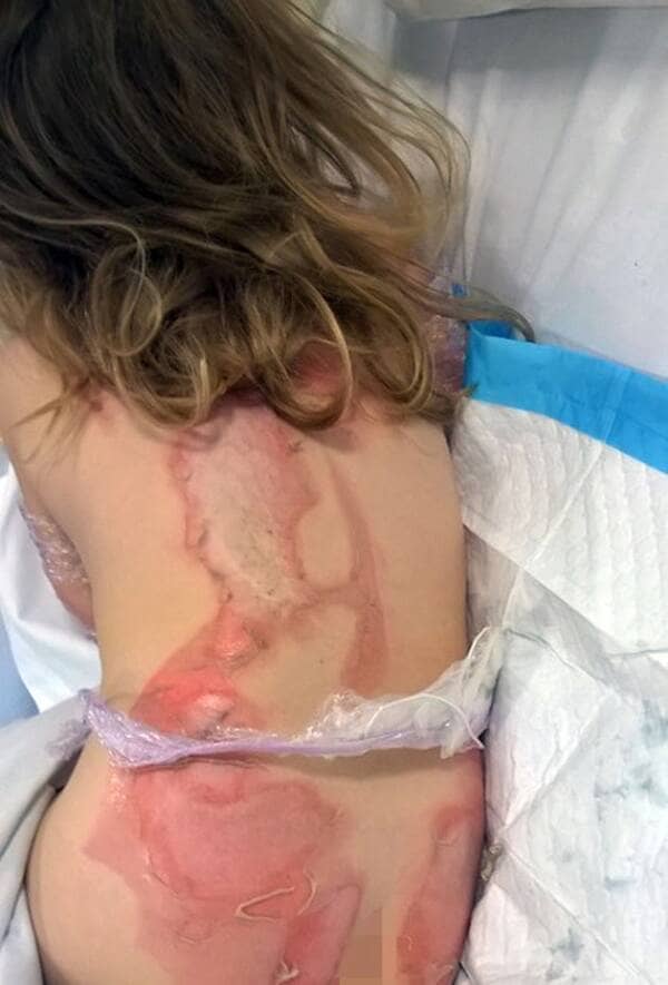 Child with bad burns on her back